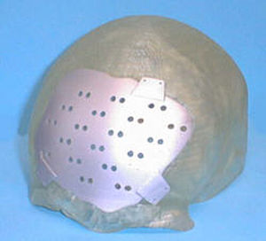 Individualimplantat für den Schädelbereich